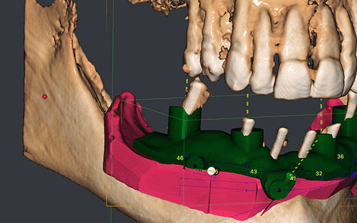 Installation of 3D Dental Planning — Treatment Planning