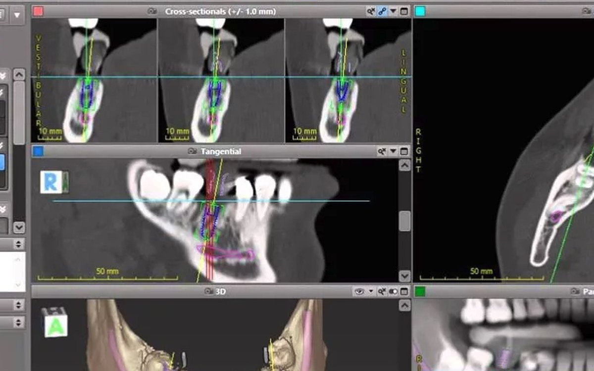 Installation of coDiagnostiX — Implant Planning