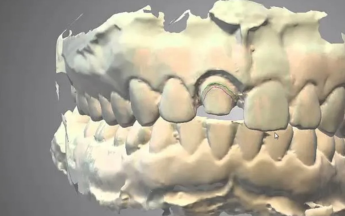 Installation of Dental Wings DWOS — CAD/CAM Software