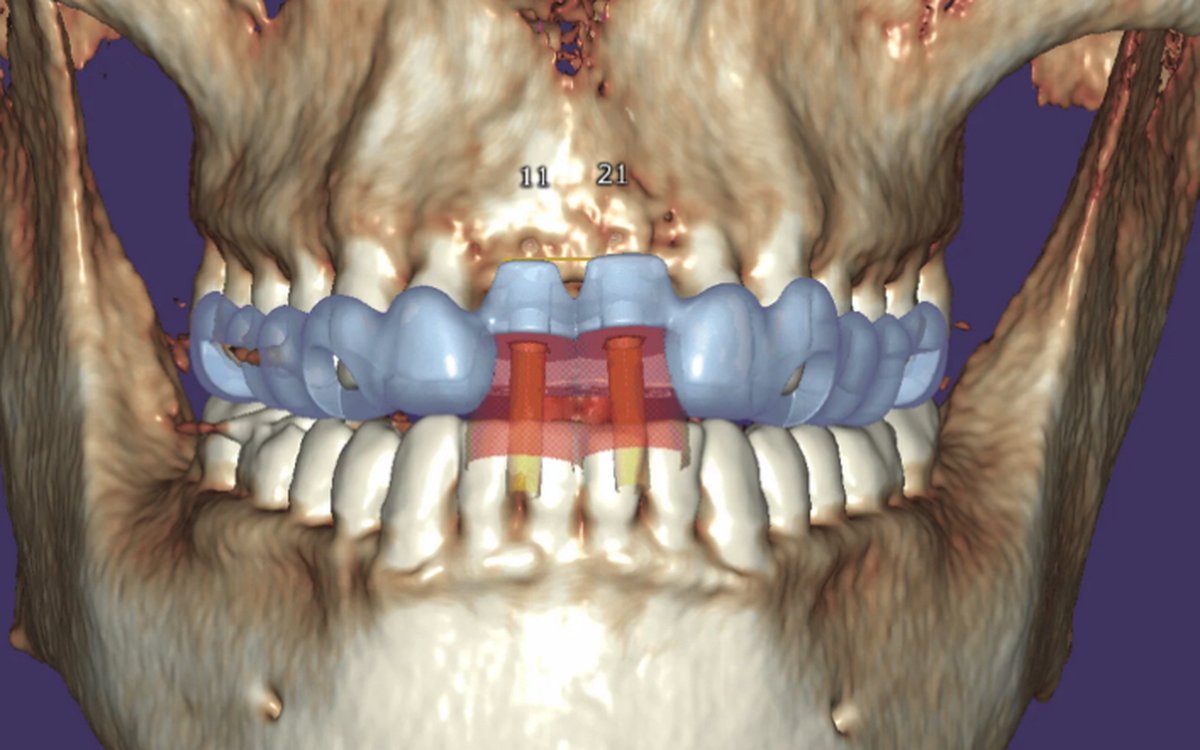 Installation of Exoplan — Implant Planning