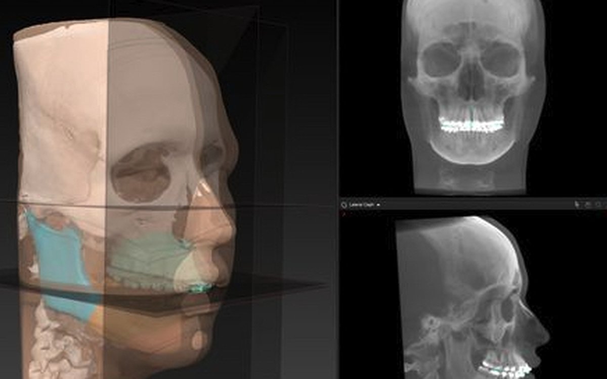 Installation of IPS CaseDesigner — CAD/CAM Software