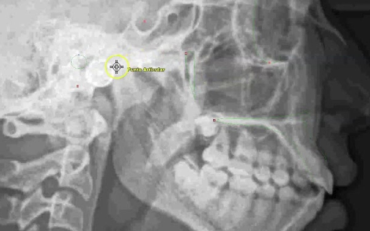 Installation of NemoCeph — Orthodontics