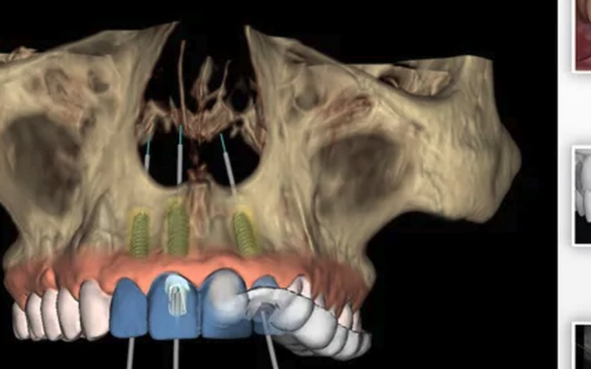 Installation of Nobel Clinician — Implant Planning
