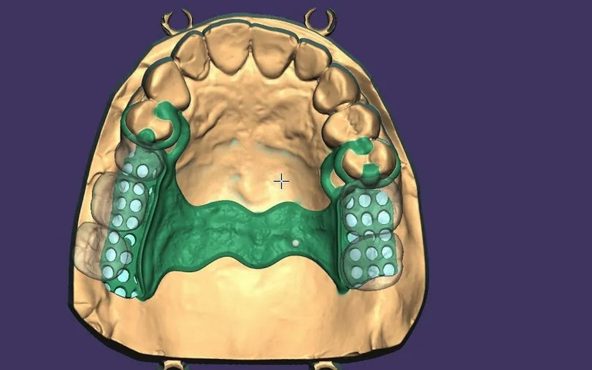 Installation of PartialCAD — CAD/CAM Software