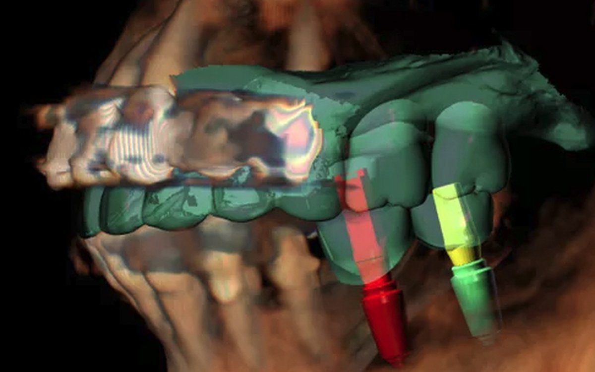 Installation of R2GATE — Implant Planning