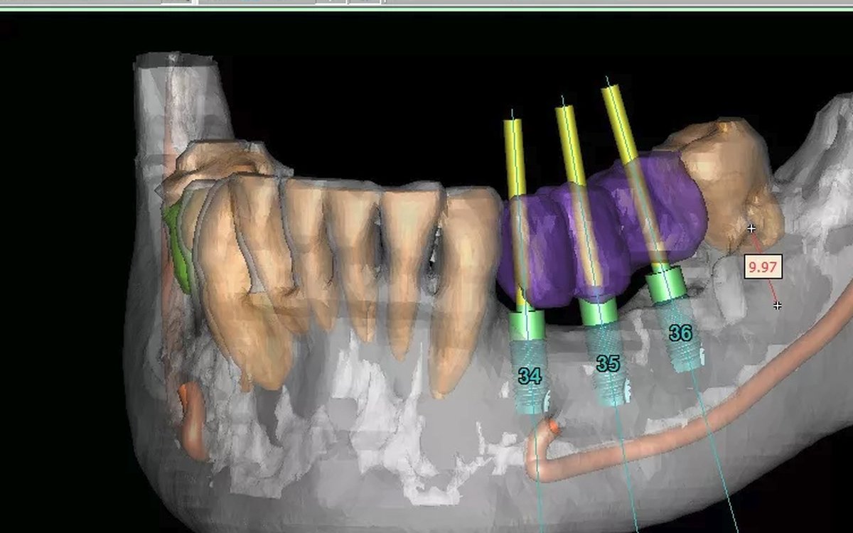Installation of Simplant Pro — Implant Planning