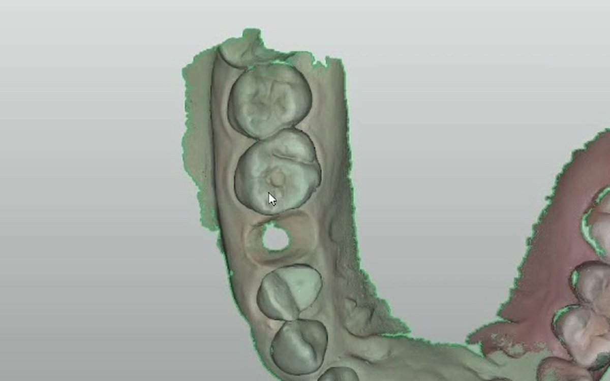 Installation of Straumann IO Software — Implant Planning